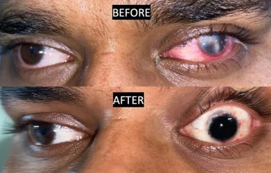 corneal-scar-treatment-1-1024x600.jpg